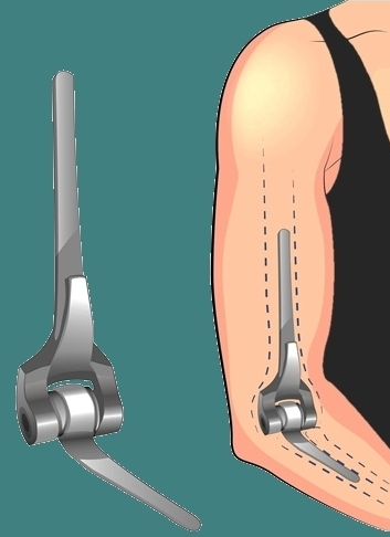 Elbow implant Elbow implant.